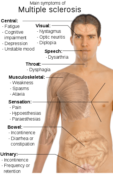 Multiple Sclerosis and cannabis Multiple Sclerosis and cannabis