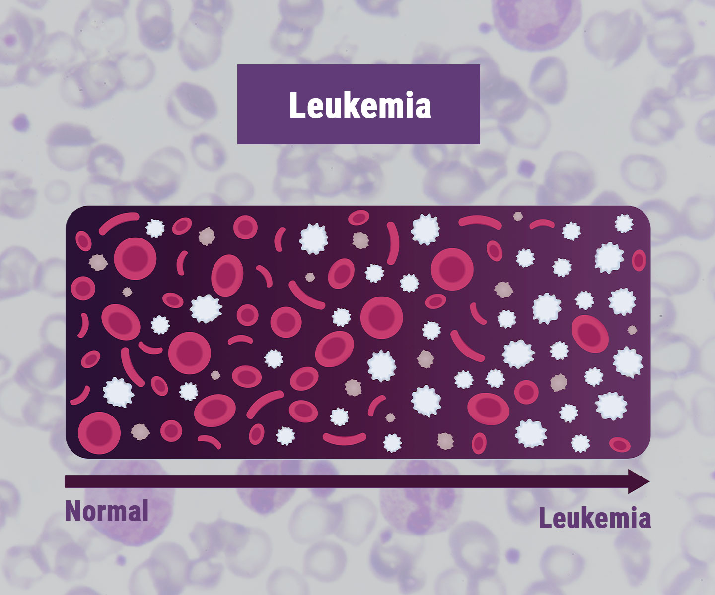 Leucemia